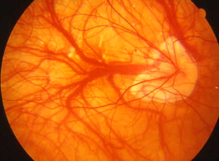 degenerazione maculare neovascolare nella  miopia patologica1