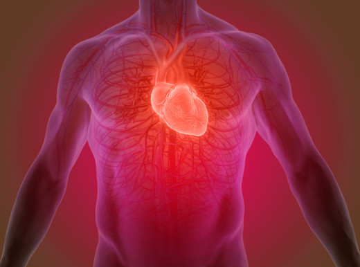 infarto del miocardio